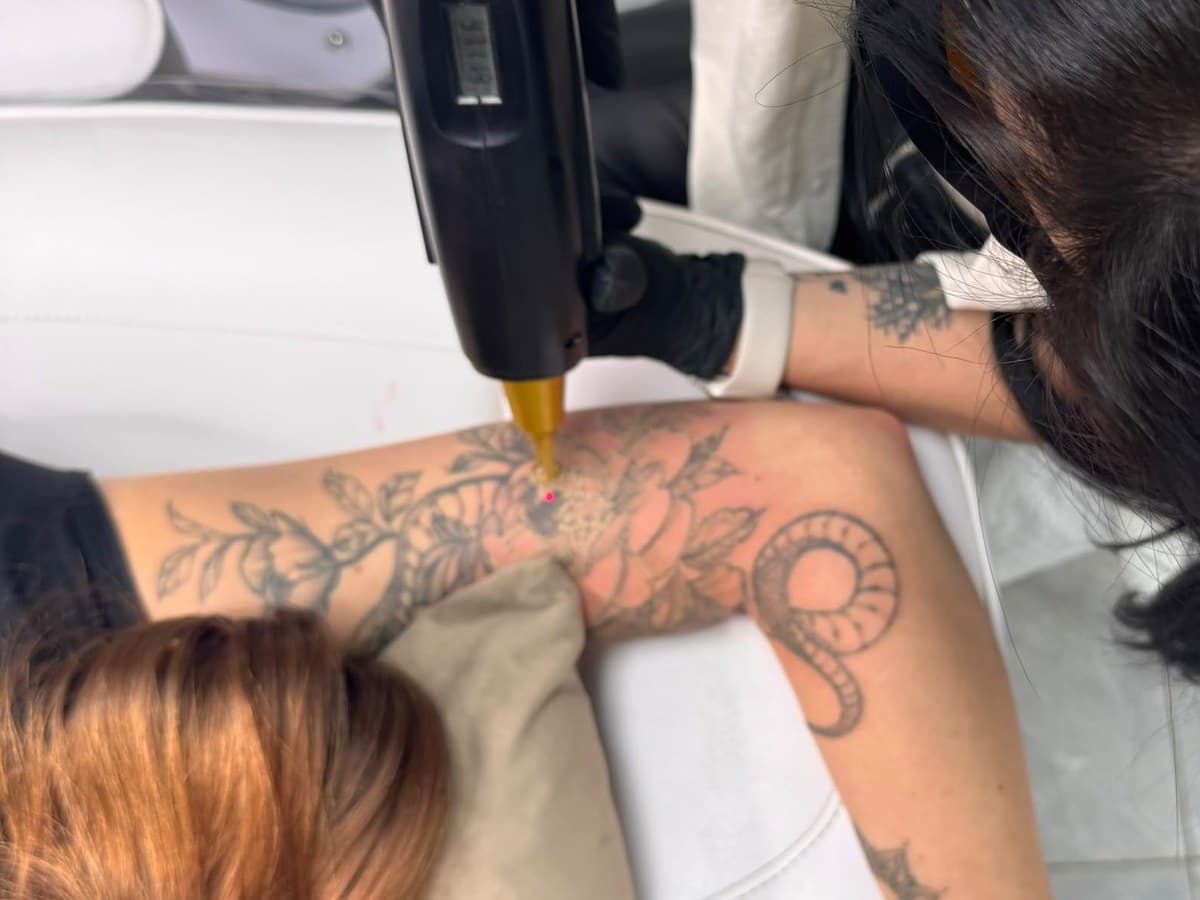 Laser tattoo removal price in Perth: what affects the cost