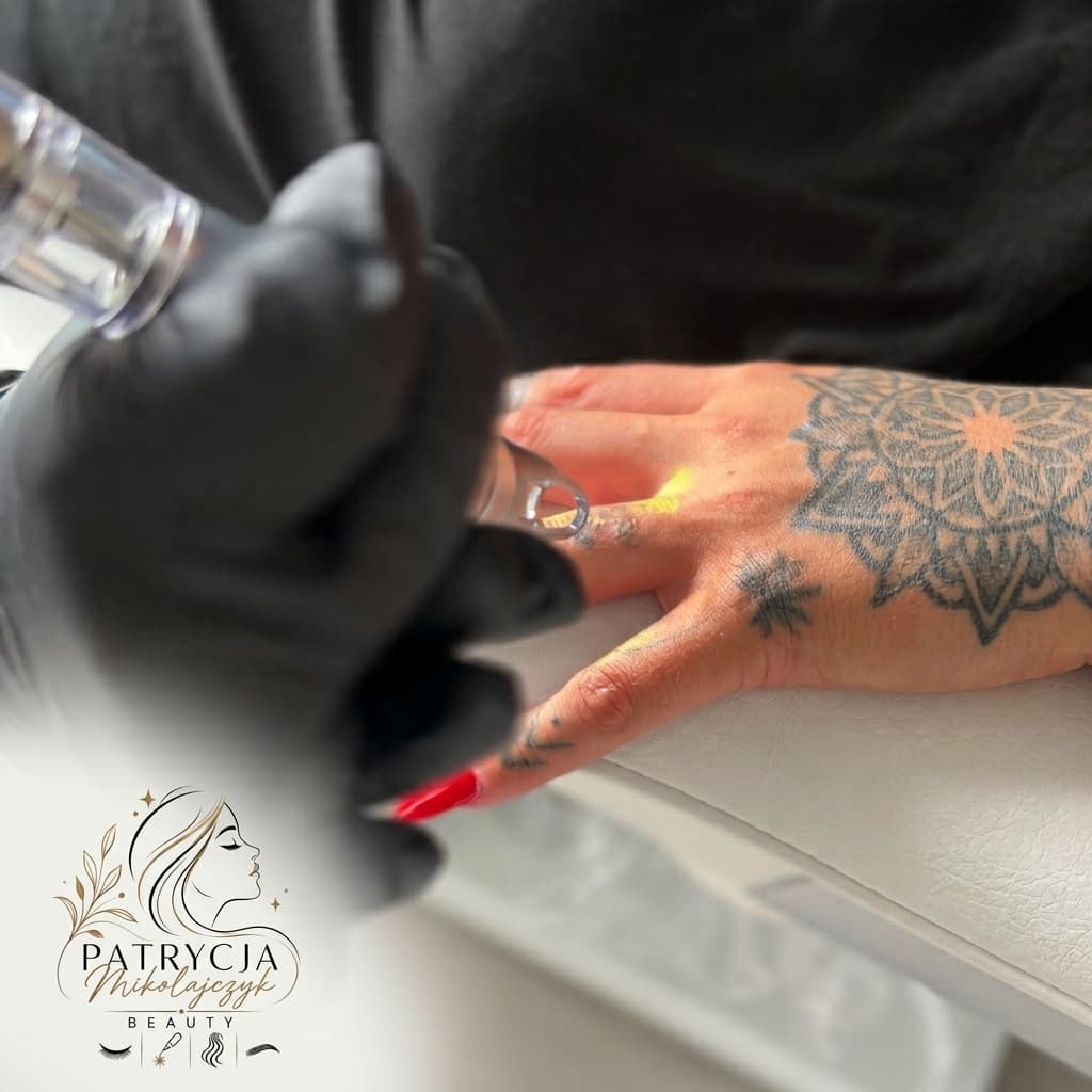 Pico laser tattoo removal in Perth: how it works and what to expect